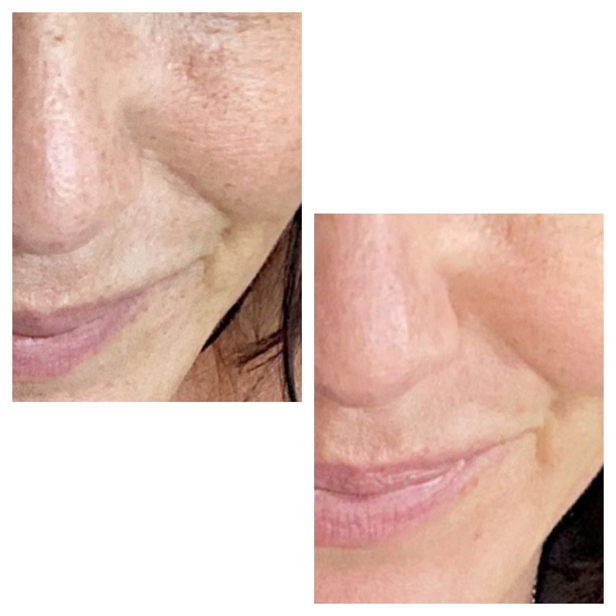 Microneedling Profi vs. Dermaroller