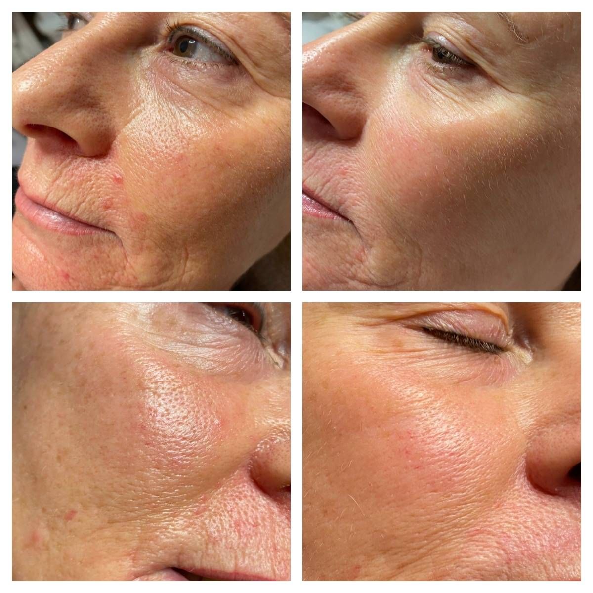 Microneedling Profi vs. Dermaroller