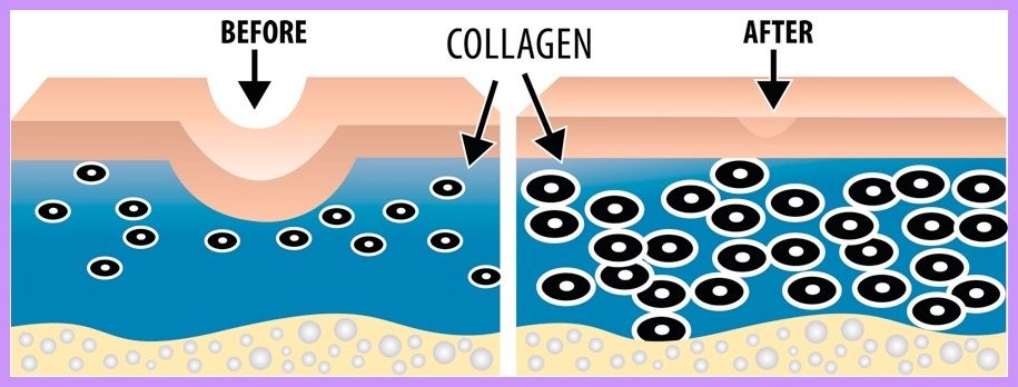 Microneedling Profi vs. Dermaroller