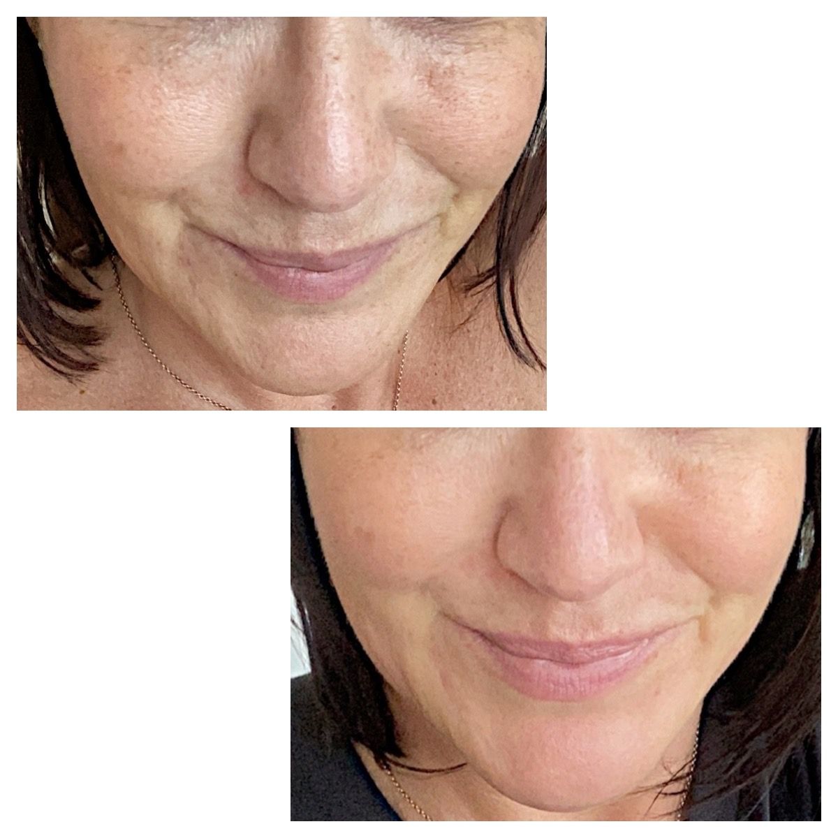 Microneedling Profi vs. Dermaroller